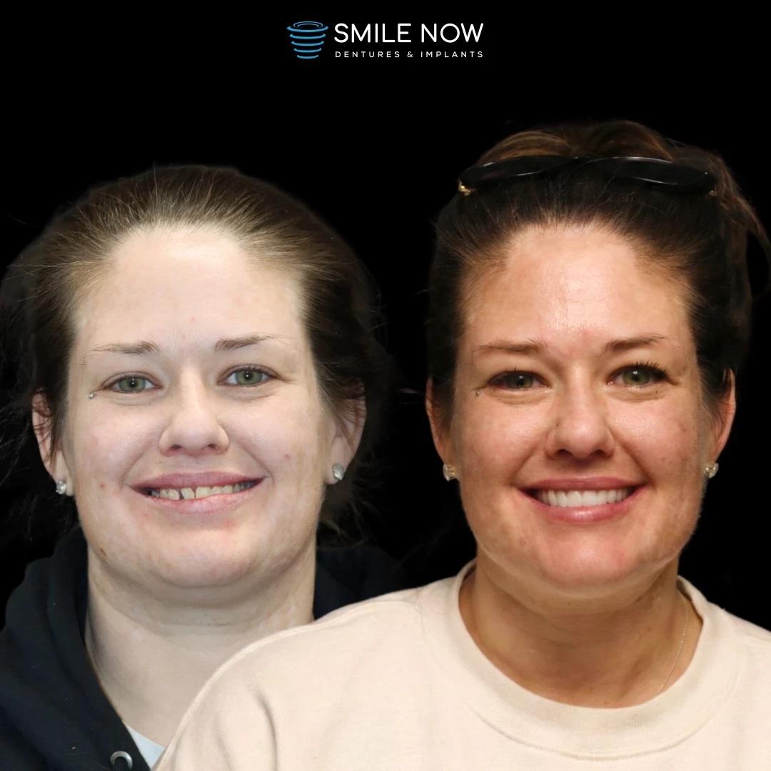 Smile Now Boise Dentures and Implants Image