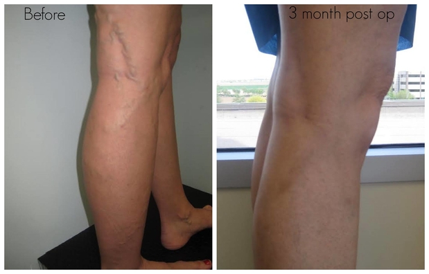 Images Optima Vein Care
