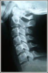 Denneroll Spinal remodeling