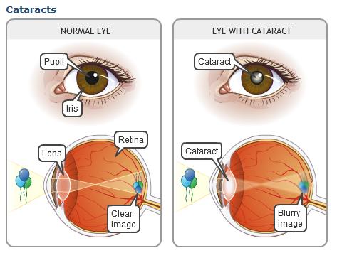 St. Luke's Cataract & Laser Institute St. Petersburg