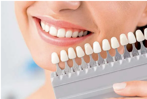 Sbiancamento dentale