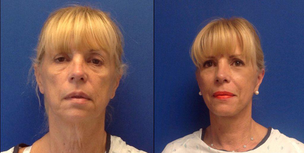 Before and After Mini Facelift.  Our patient Susie is ecstatic with her results from her mini facelift.  Her neck and face look 20 years younger!  