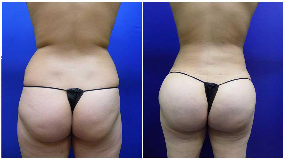 Denver Liposuction Specialty Clinic Photo