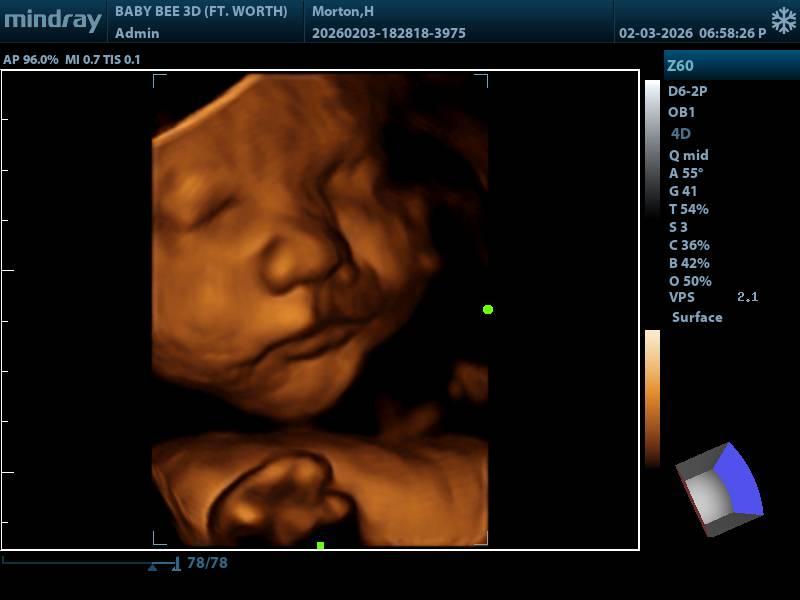 Baby Bee 3D Ultrasound (Fort Worth/NRH)