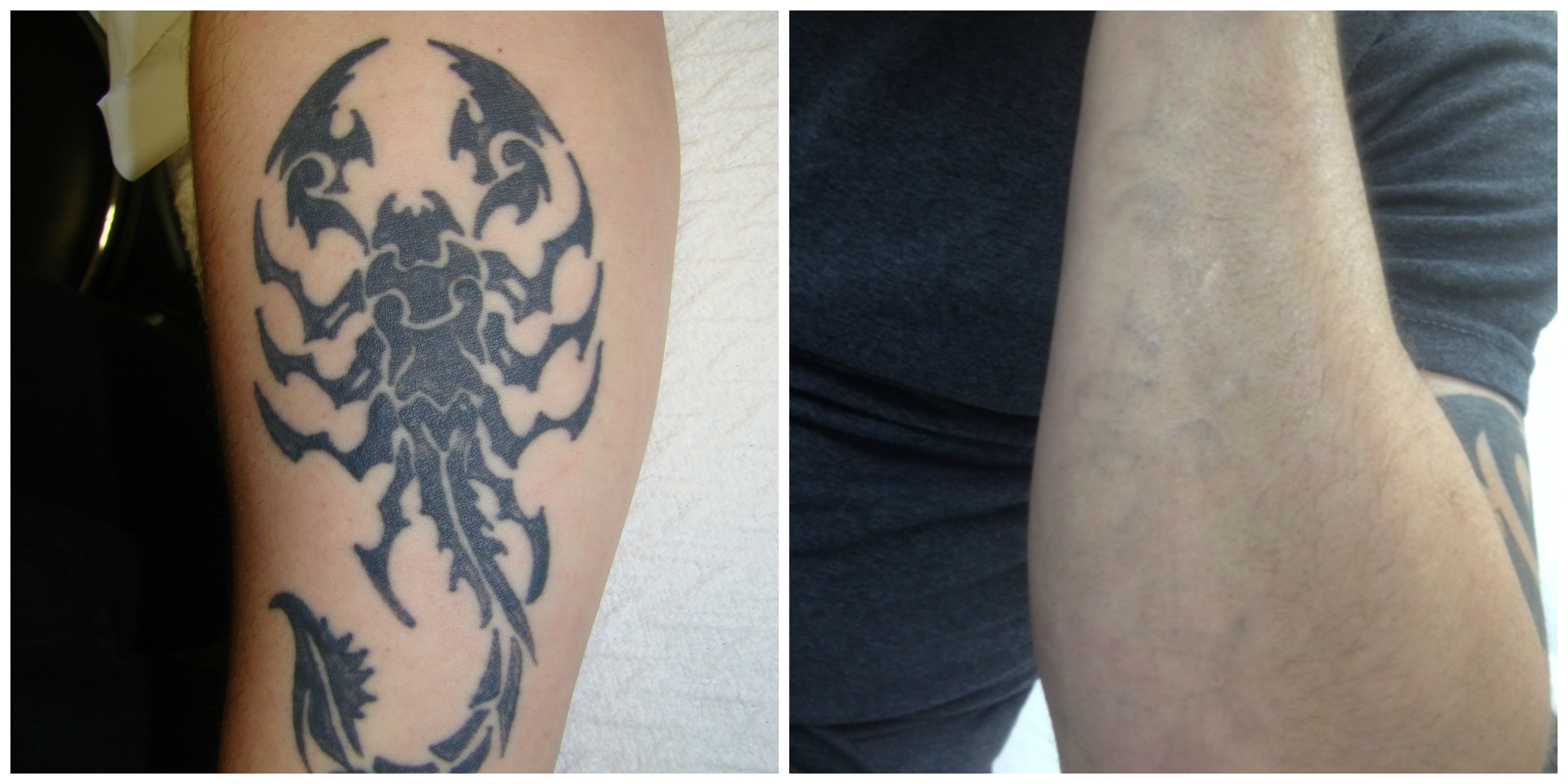 East Coast Laser Tattoo Removal Photo