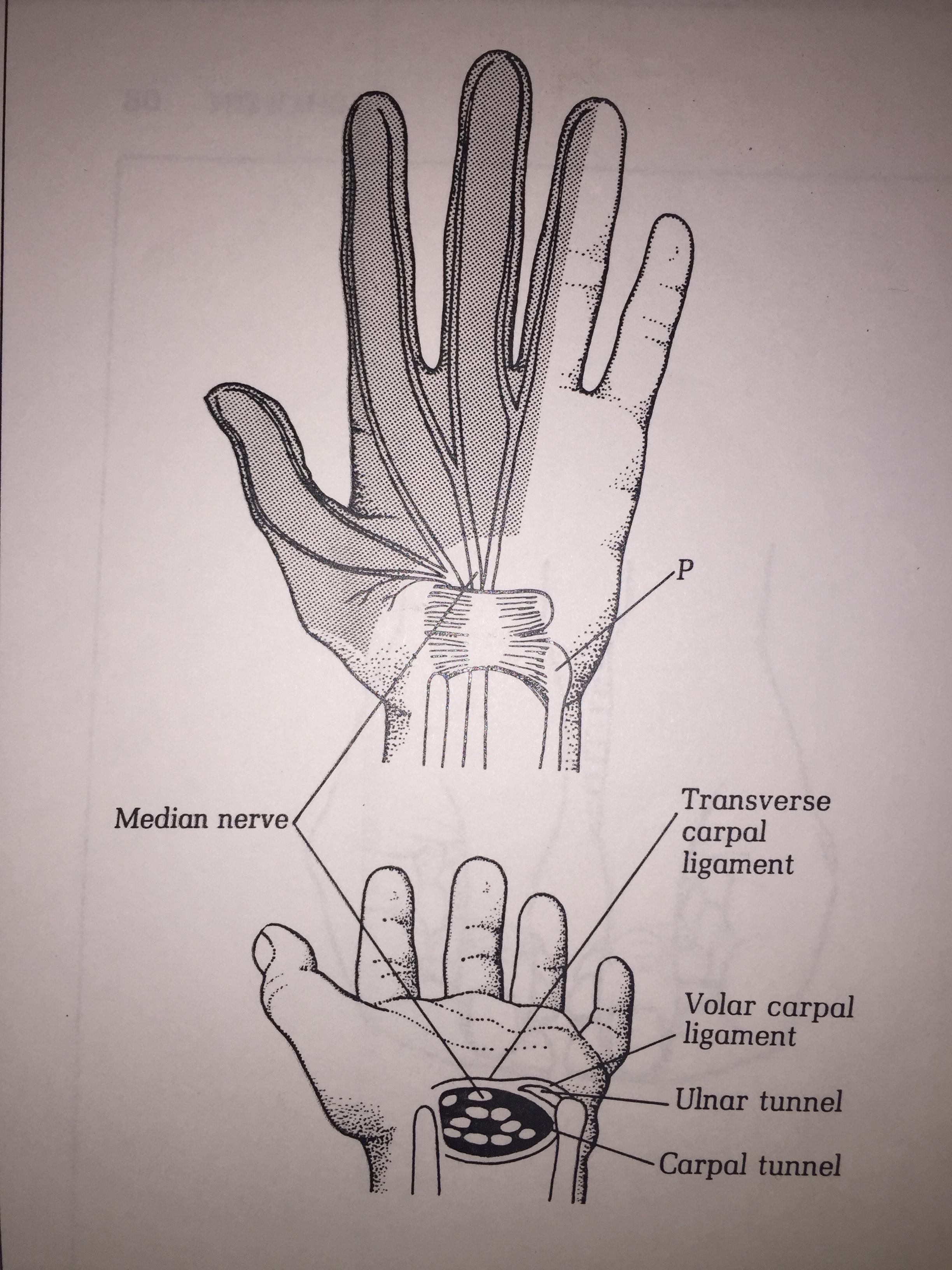 Median nerves  at wrist is the  most commonly affected nerve and is called Carpal Tunnel Syndrome.