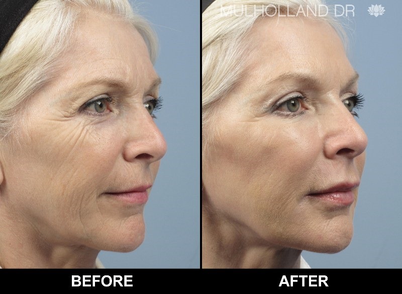 Morpheus8 Rf Microneedling