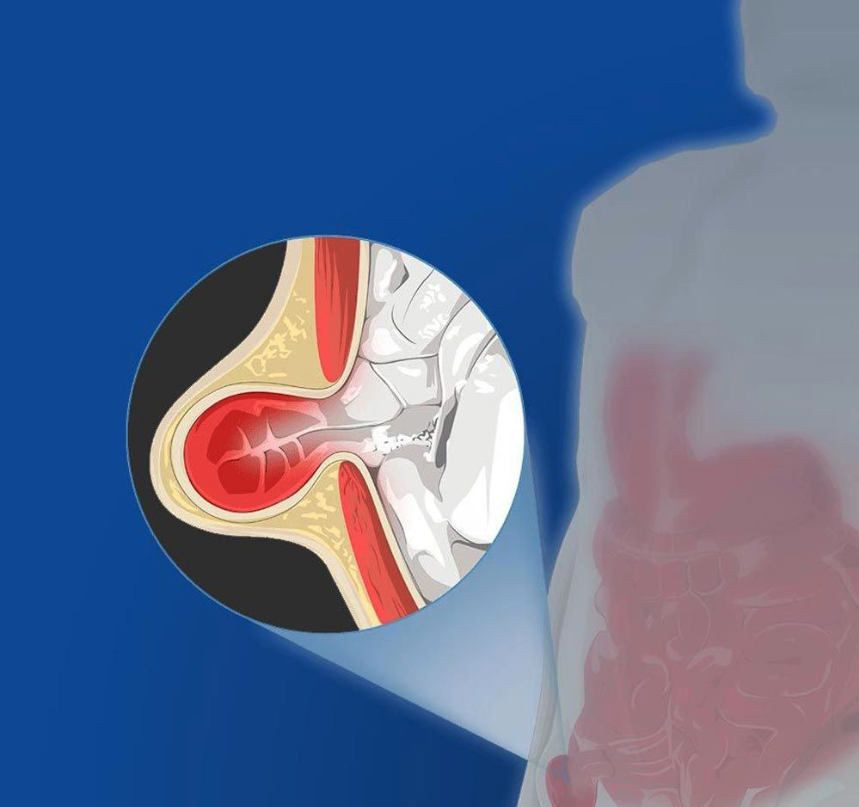 Hernia Surgery