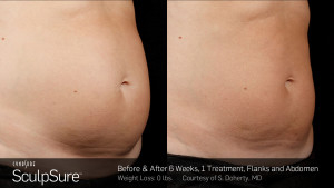 SculpSure – Non-Invasive Fat Reduction