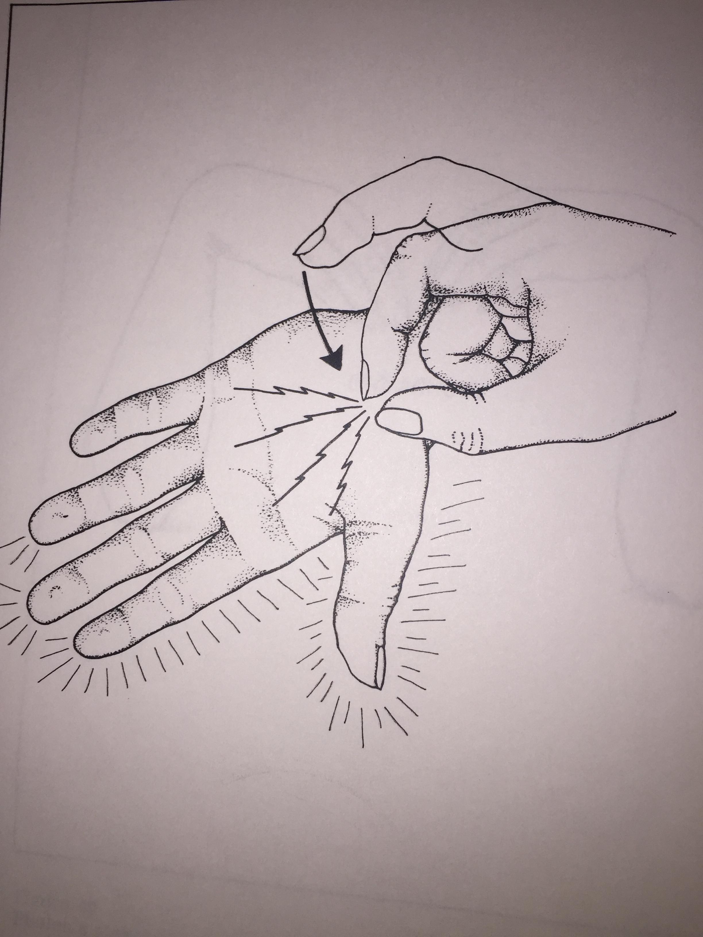 Tapping on the nerve at the wrist causes tingling in the hand and is called tinnel Sign.
