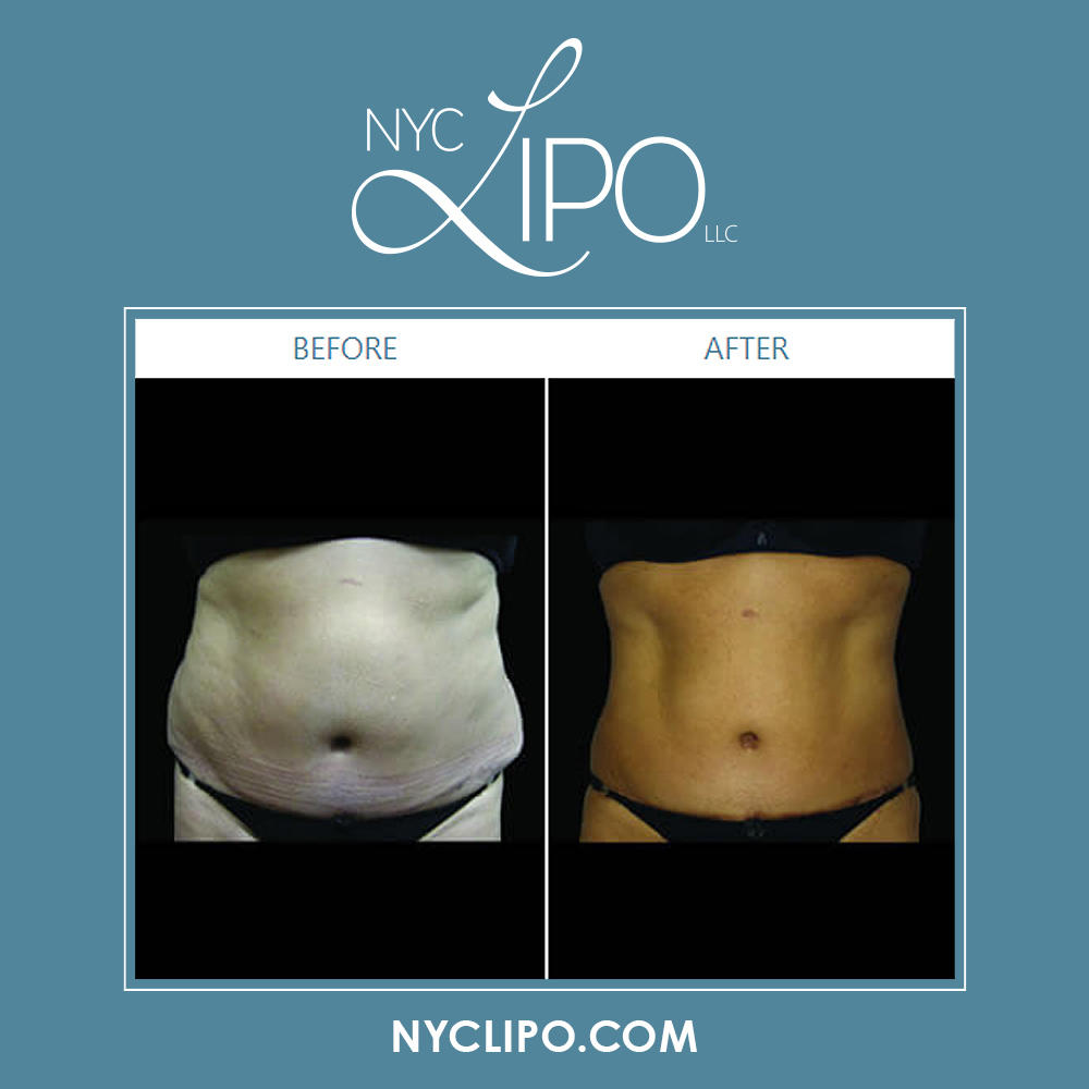 NYC Lipo LLC Photo