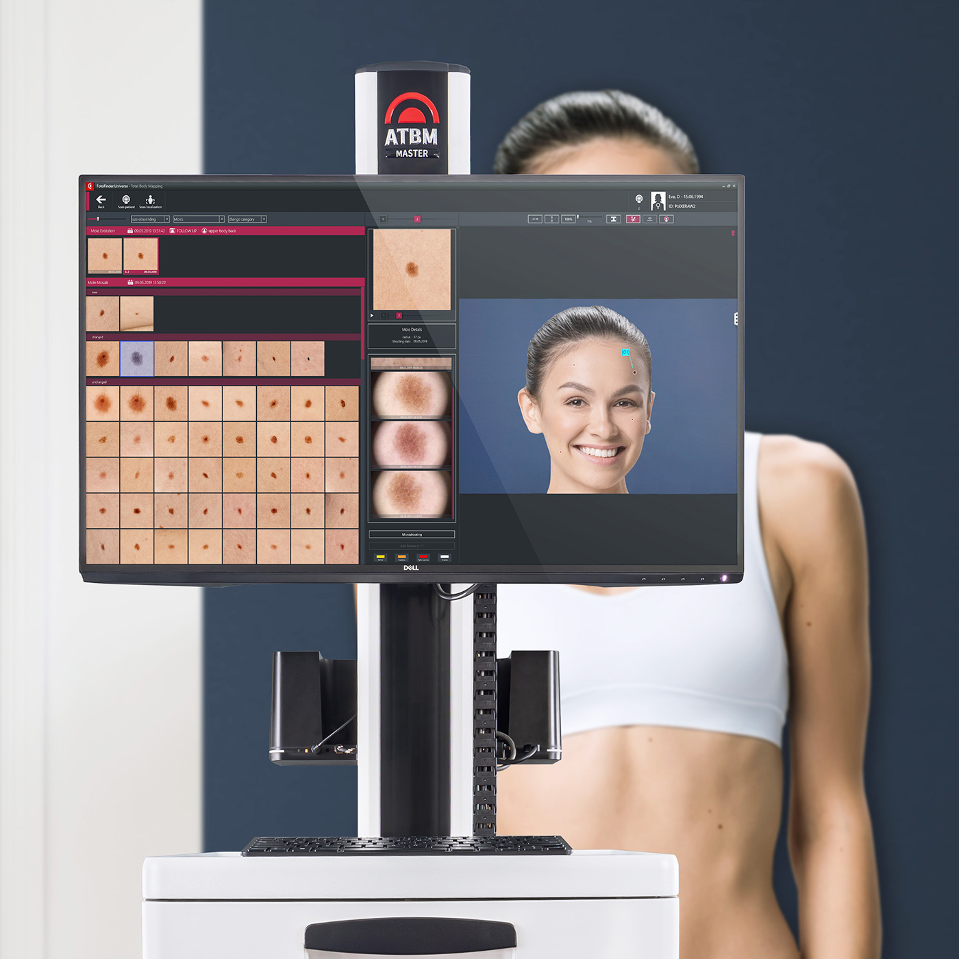 Skin Cancer Screening with FotoFinder