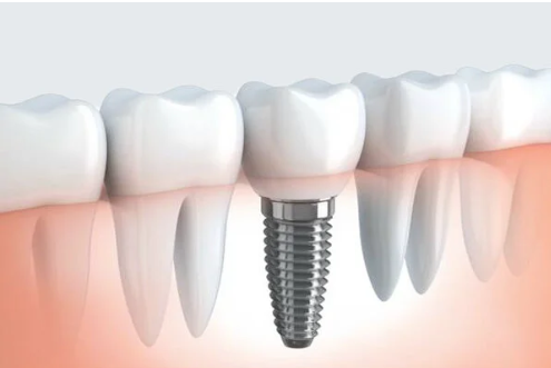 Impianti dentali