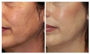 Chemical Peels