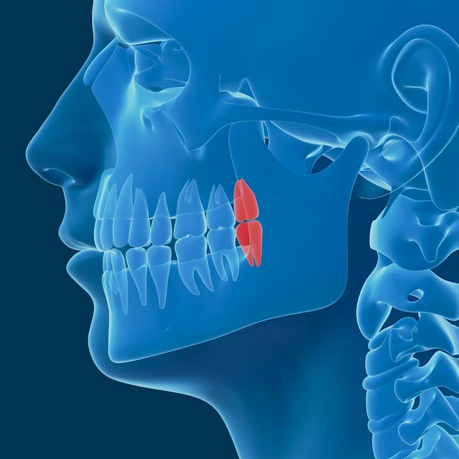 Wisdom Teeth Removal