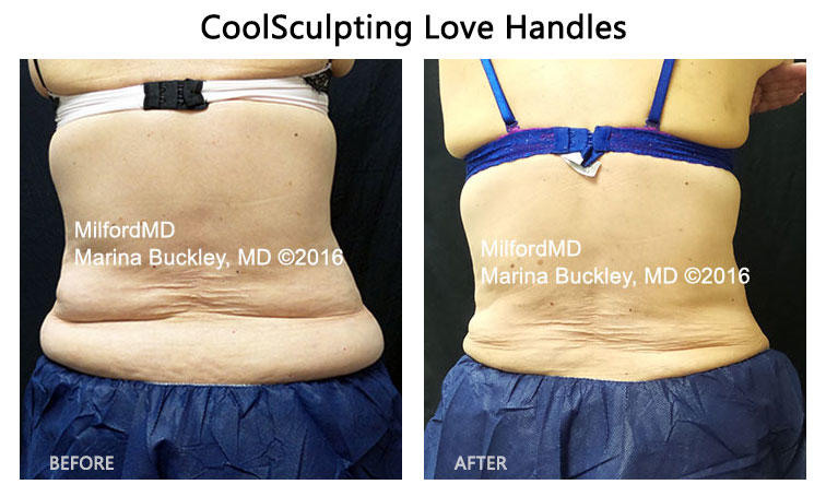 CoolSculpting