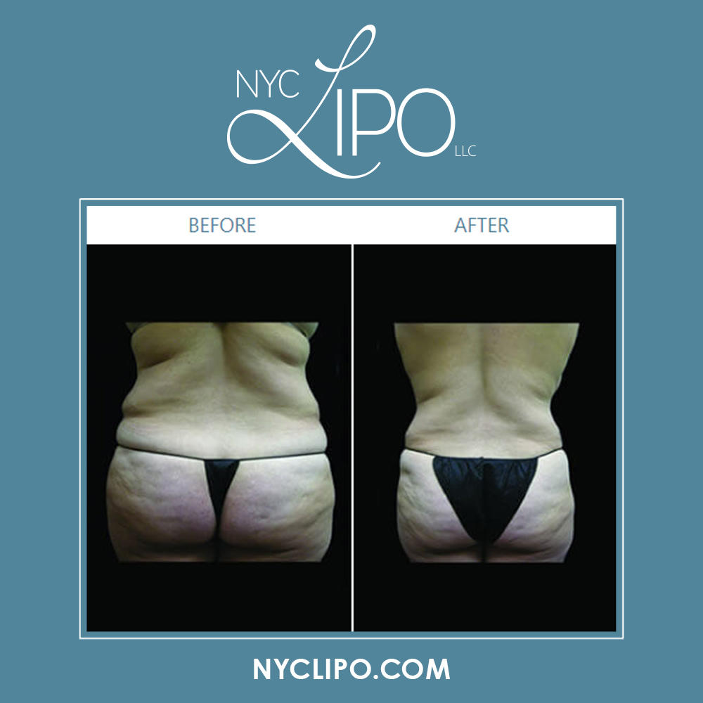 NYC Lipo LLC Photo