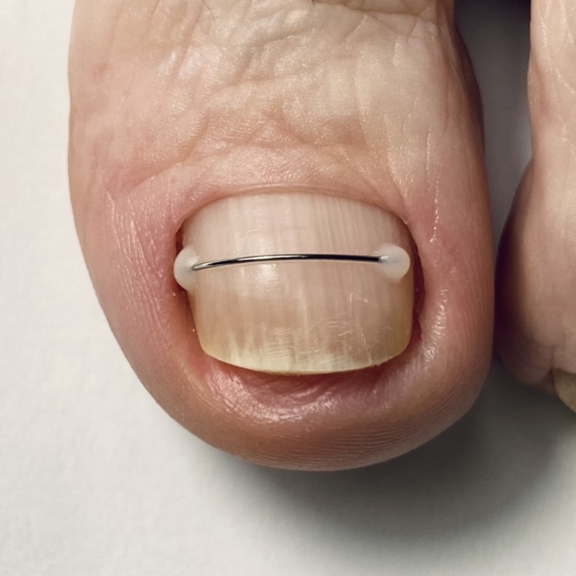 Nail Correction System for Ingrown Toenails