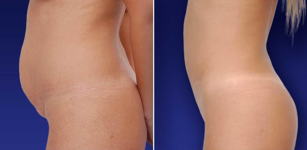 Chicago Liposuction by Lift Body Center Photo