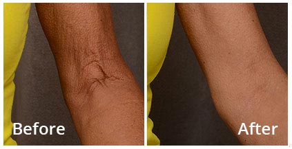 Forma- RF Skin tightening