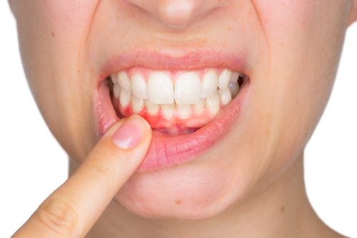 Periodontal Disease (Gum Disease)