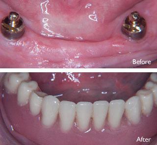 Dentures