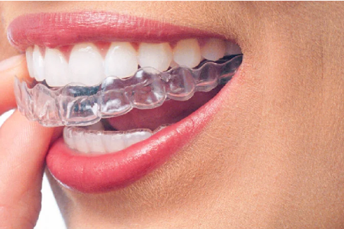 Invisalign: l'alternativa all'apparecchio ortodontico