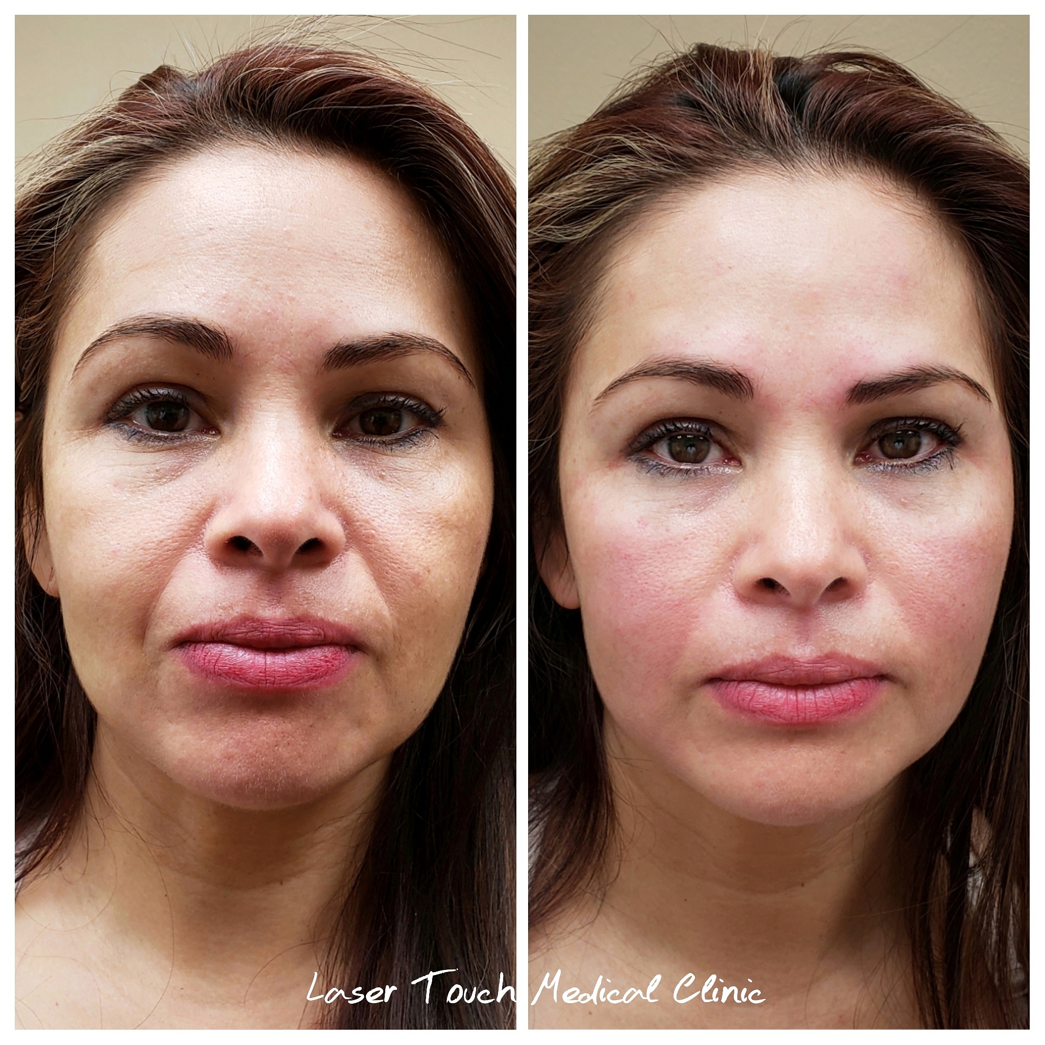 Happy holidays, happy holidays... Ok I'm done singing now  Let's talk about our client's transformation, without those pesky laugh lines she's ready for all the holiday festivities . . . ââ##BULLET##ï¸Treatment: Juvederm Purpose: Fill and smooth out laugh lines Anesthesia: Topical Procedure Time: 15- 60 minutes âResults: Immediately Lasts: 8-10 months Pain Level: Varies, very mild to mild Notes: Individual results may vary â