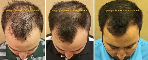 LASER HAIR GROWTH - REDUCE THINNING HAIR, REGROW HAIR