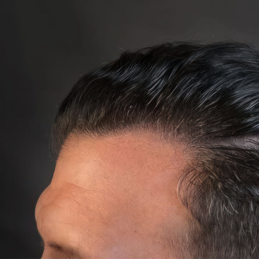FUT Hair Transplant