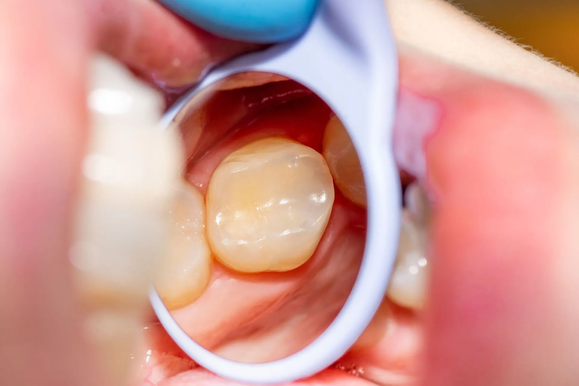 Metal-Free Fillings