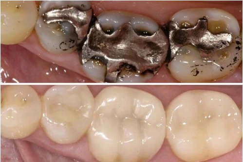 Otturazioni in composito ceramica CEREC