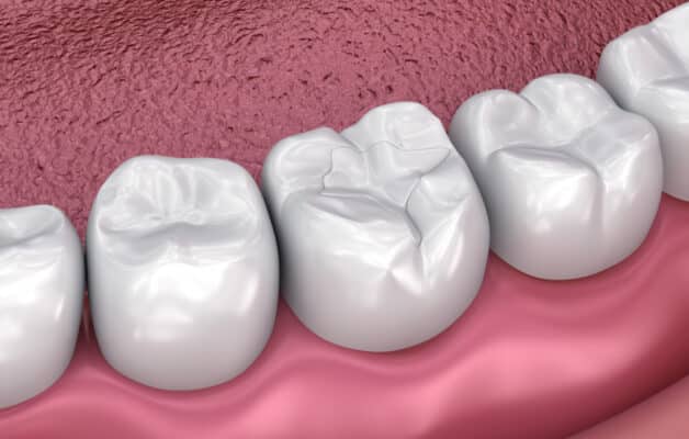 Tooth-Colored Fillings