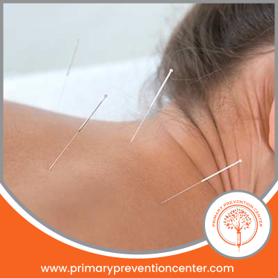 Acupunctire