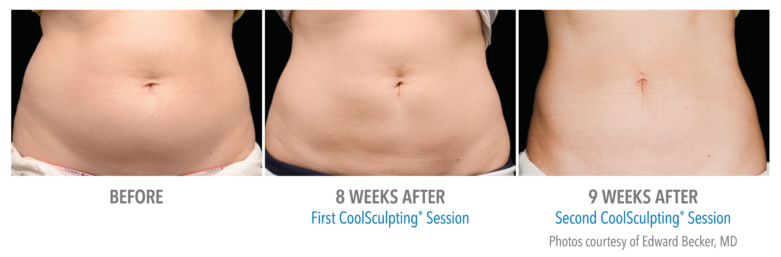 Coolsculpting
