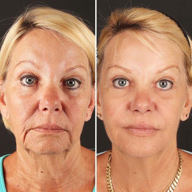 Images Renew Body Contouring