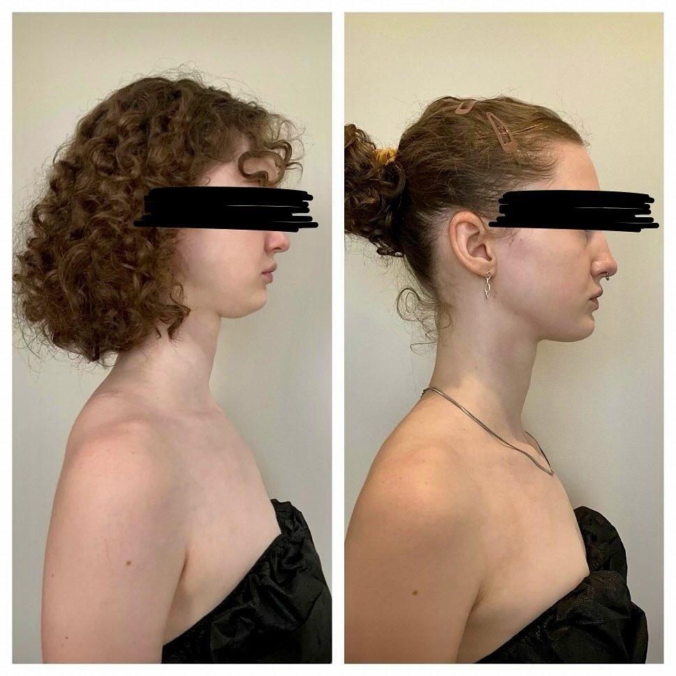 BodyLuxe | FormSculpt Awake Liposuction & Fat Transfer by Daniel J Farrugia MD PhD FACS Image