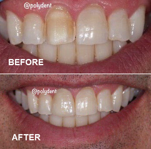 Images Poly-Dent Ceramic