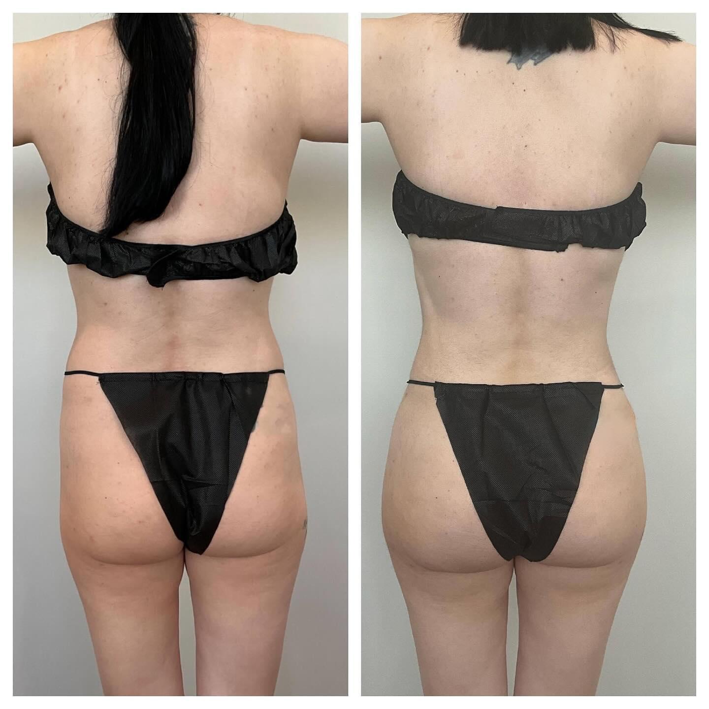 BodyLuxe | FormSculpt Awake Liposuction & Fat Transfer by Daniel J Farrugia MD PhD FACS Image