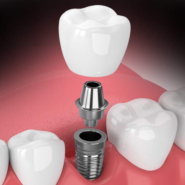 Dental Implants