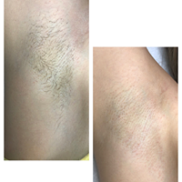 Electrolysis Center Permanent Hair Removal Photo