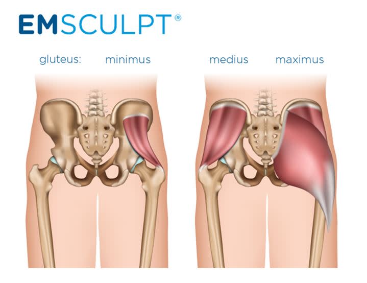 Columbus Emsculpt Photo