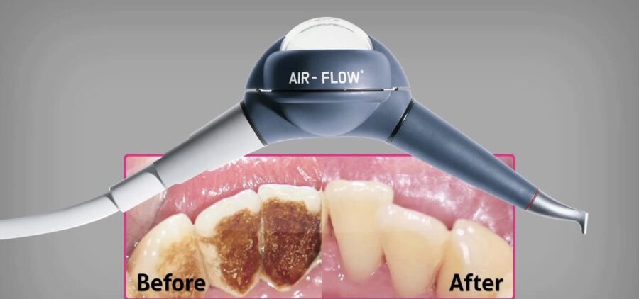 Igiene Dentale Professionale