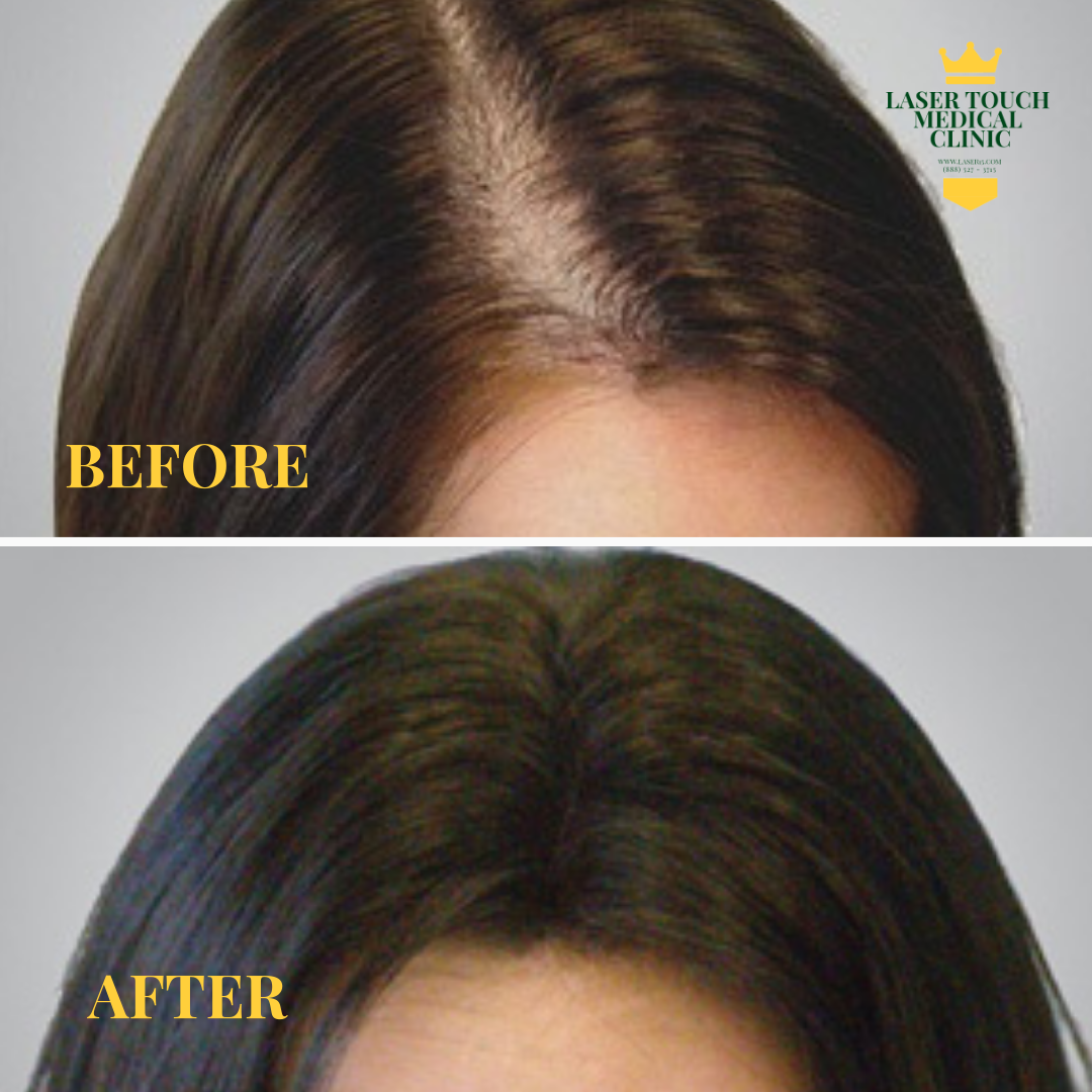 Benefits of PRP Hair Treatments include: Natural Treatment Contains essential proteins that stimulate natural hair growth. Causes miniaturized hair follicles to become healthier and larger, producing more robust hair growth Loaded with growth factors that promote rapid angiogenesis and localized cell growth. Has also regrown hair in alopecia areata, eyebrow hypotrichosis and other patient cases with non-hereditary hair loss. Promotes blood vessel growth, cell replication, skin formation Promotes blood vessel formation Promotes cell growth and differentiation, blood vessel formation, collagen formation.