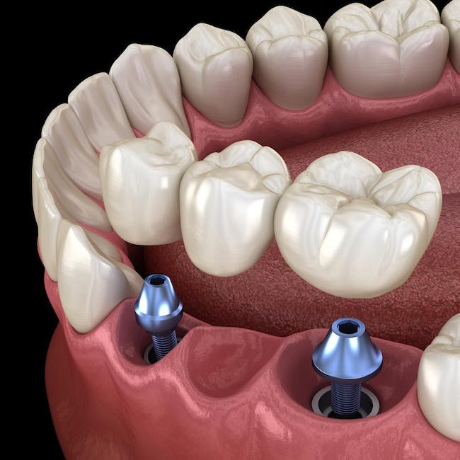 Dental Bridges