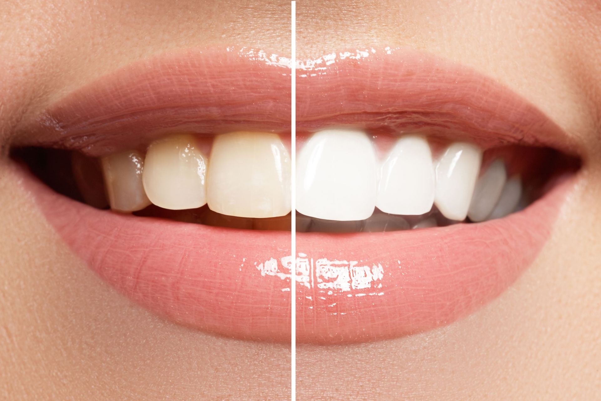 In-Office Whitening