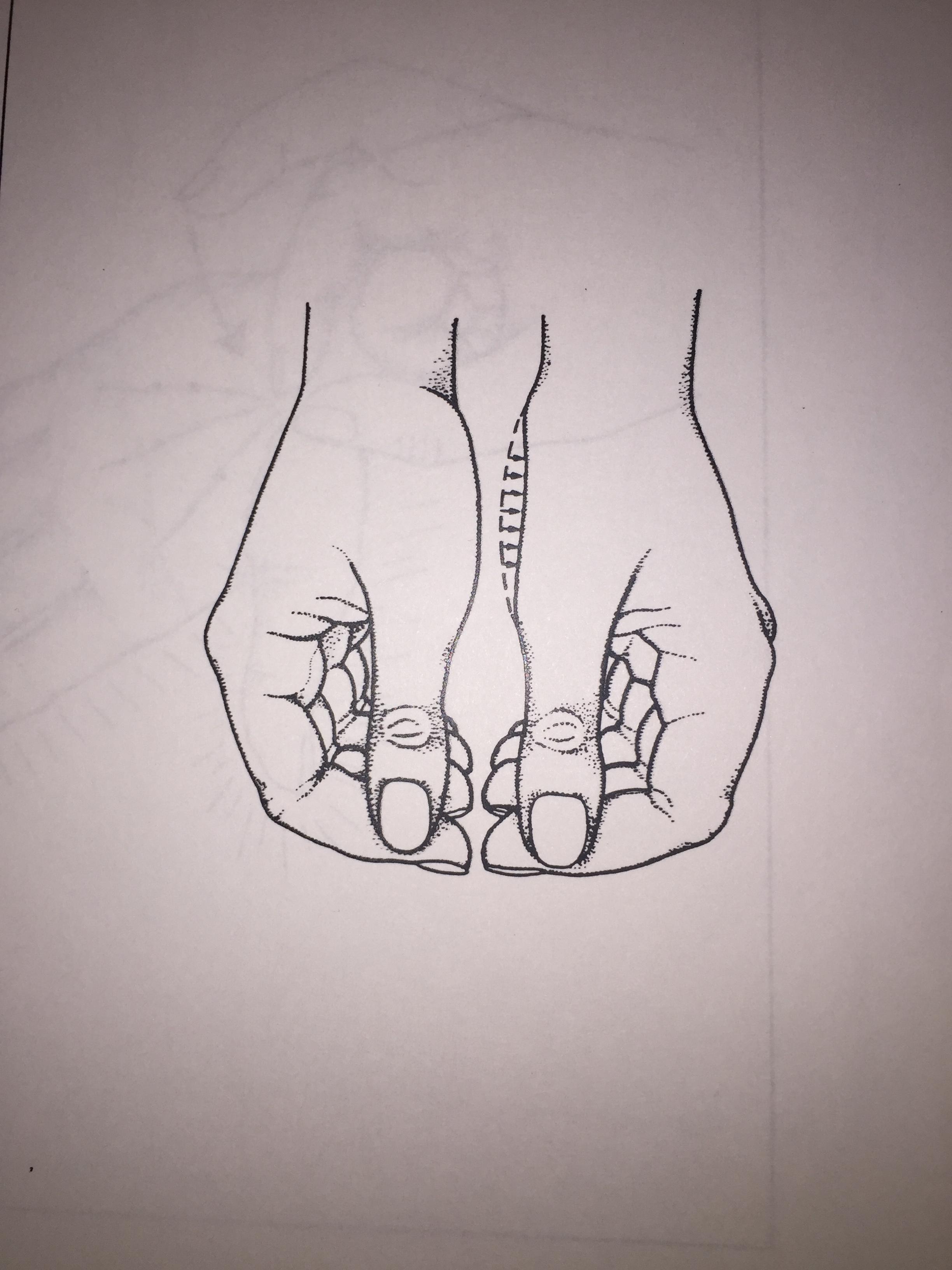 In severe cases of Carpal Tunnel Syndrome Atrophy (degeneration of muscle cells)  of the thenar muscles could be seen.