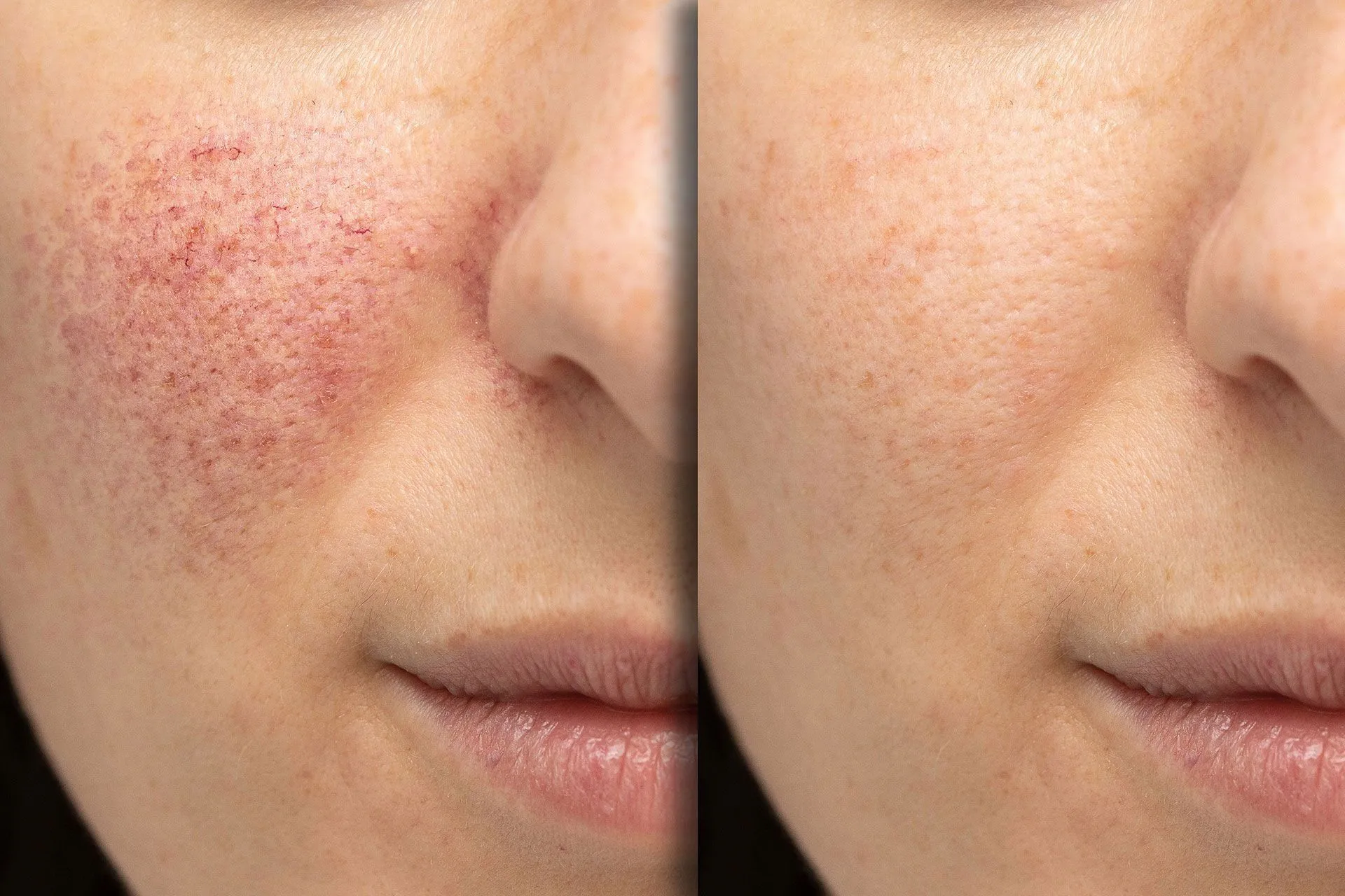 Dermatology
