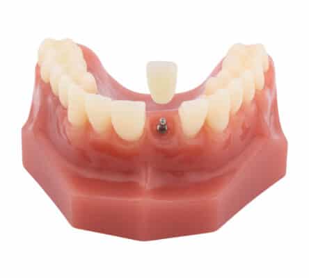 Dental Crowns