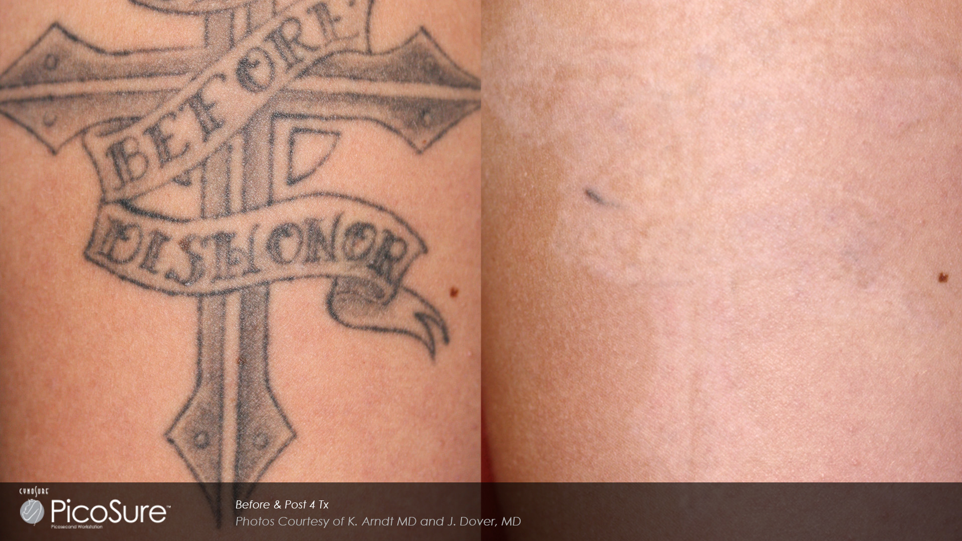 Inklifters Tattoo Removal Photo